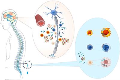 The Cerebrospinal Fluid in Multiple Sclerosis